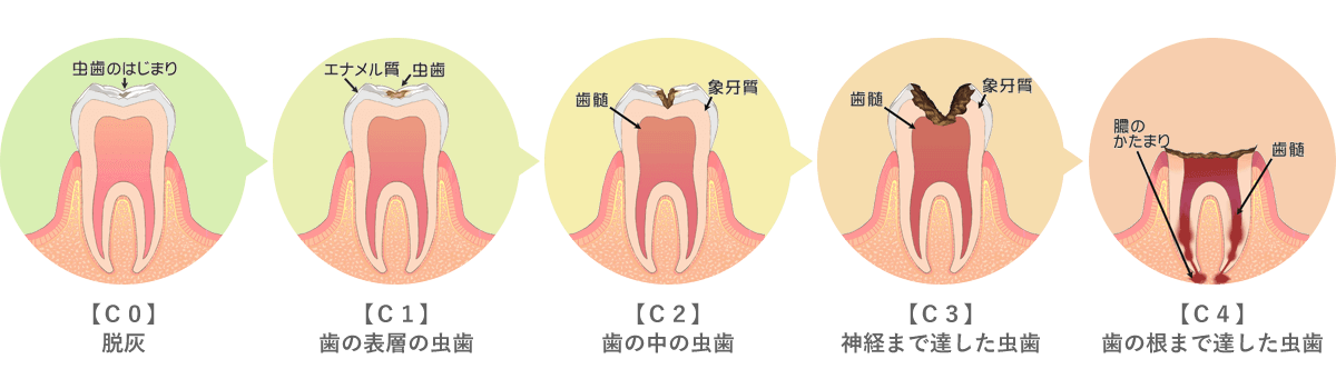 虫歯の進行