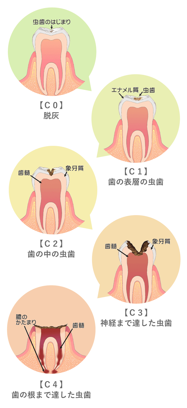 虫歯の進行