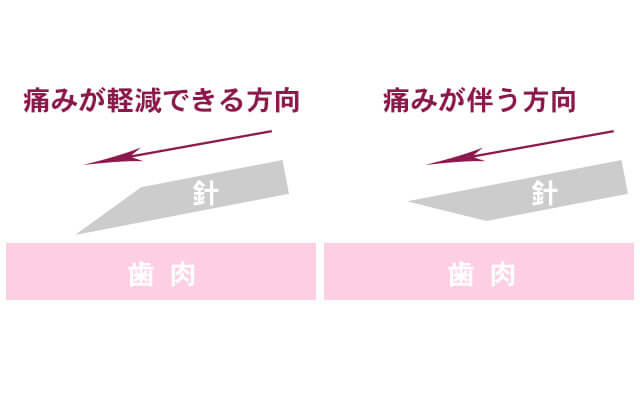 針が刺さる方向の工夫