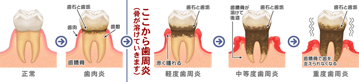 歯周病の進行