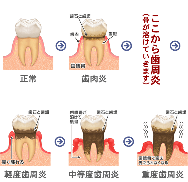 歯周病の進行