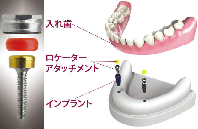 磁石式入れ歯（マグネットデンチャー）