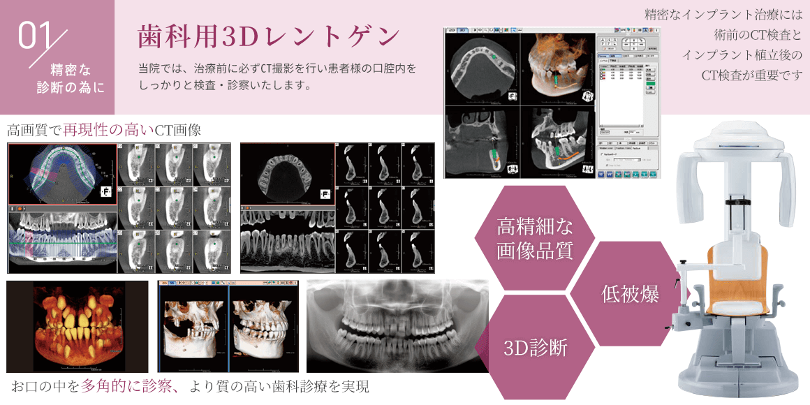 CTレントゲン