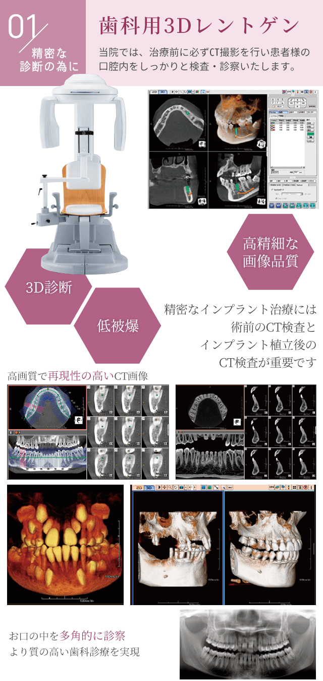 CTレントゲン